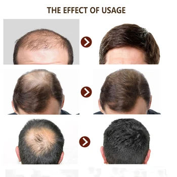 11.11 PURC Naujas Produktas, 30ml Plaukų Priežiūros Gydymą, Plaukų Augimas Purškimo Imbiero Ekstraktas Išvengti Plaukų Slinkimas, Vyrų ir Moterų