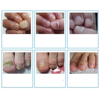 10ml Kinų Medicinoje Žolės Kojų Nagų Grybelio Gydymas, Masažas Kovos Grybelinės Nagų Infekcijos Nagų Priežiūros Masažas pleistras D132